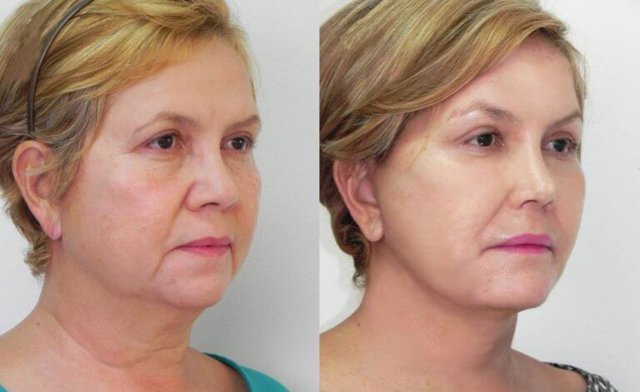 SMAS лифтинг лица. Ultra Подарки Тюмень. Подарочный сертификат на SMAS лифтинг лица. Ultra Подарки Тюмень. 8 800-505-9503. SMAS лифтинг лица  #вМоскве#