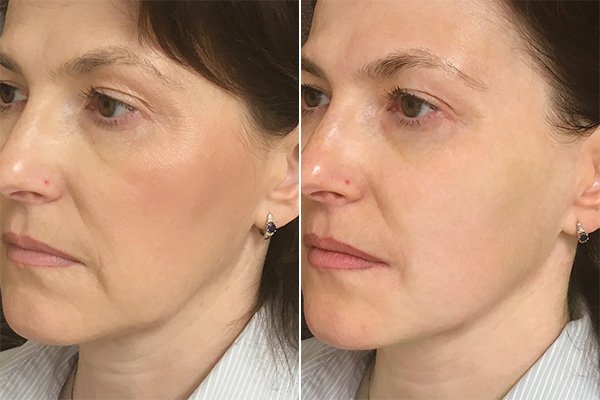 SMAS лифтинг лица. Ultra Подарки Тюмень. Подарочный сертификат на SMAS лифтинг лица. Ultra Подарки Тюмень. 8 800-505-9503. SMAS лифтинг лица  #вМоскве#