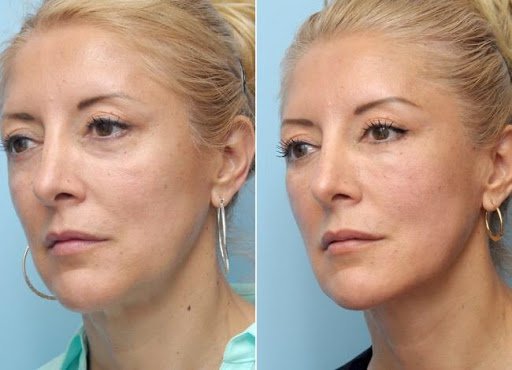 SMAS лифтинг лица. Ultra Подарки Тюмень. Подарочный сертификат на SMAS лифтинг лица. Ultra Подарки Тюмень. 8 800-505-9503. SMAS лифтинг лица  #вМоскве#